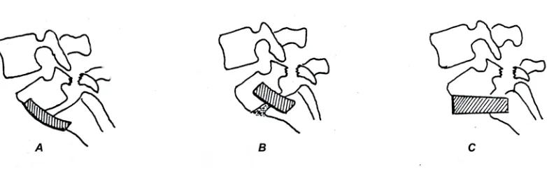 Fig. 1.9. Técnicas de artrodesis anterior con injerto encastrado. A. Sicard;         B
