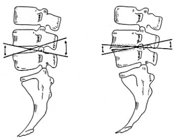 Fig. 1.11. Desplazamiento del centro de rotación en flexo-extensión en el  segmento artrósico o listésico