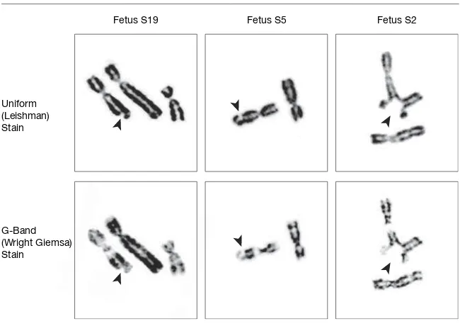 Table 6. Expression of ChromosomalAbnormalities on the Most AffectedChromosome Bands (5q31, 11q23, and17q21) From Fetuses Carried by MothersWho Smoke and From Nonsmoking Controls