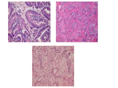 Figure 1. A) Histologically normal prostate gland with well-developed secretory epithelium forming papillary infoldings into the alveoli