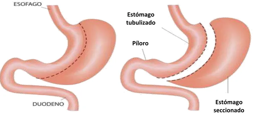 Figura  3.  Gastrectomía  vertical  