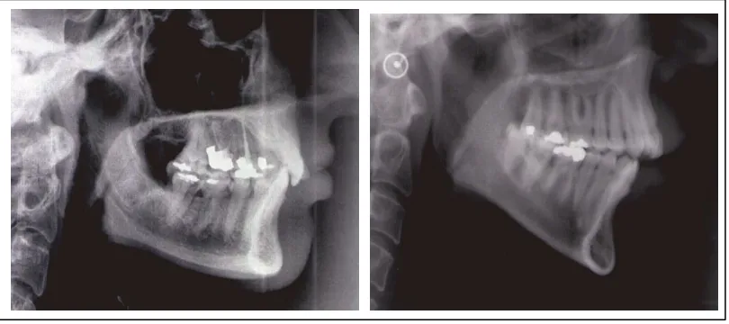 Figura 5: Diferencias en la morfología de la sínfisis mandibular en patrones faciales hipodivergentes e hiperdivergentes