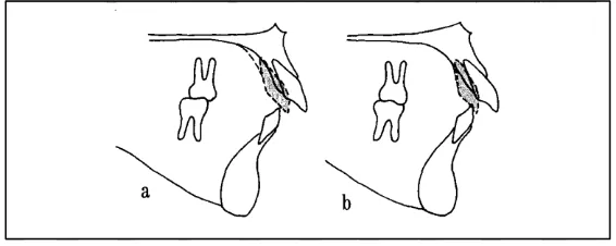 Figura 11: Tomado de Handelman. A: presunción de que el alveolo puede remodelarse en su totalidad B: presunción de que el alveolo a nivel del ápice no puede remodelarse y limita el movimiento dental