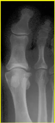 Fig. 3.10. Proyección dorsoplantar      Fig. 3.11. Proyección lateral de 