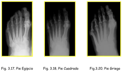 Fig. 3.17. Pie Egipcio          Fig. 3.18. Pie Cuadrado           Fig.3.20. Pie Griego 