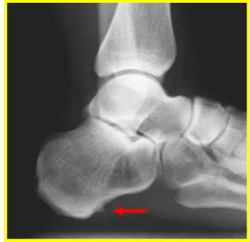 Fig. 3.21 Espolón calcáneo. 