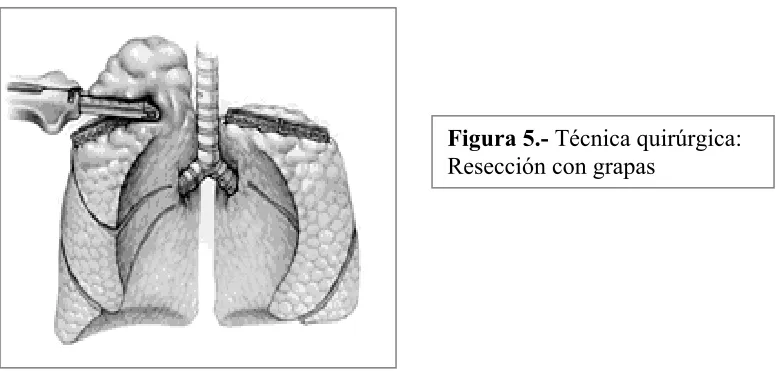 Figura 5.- Técnica quirúrgica: 