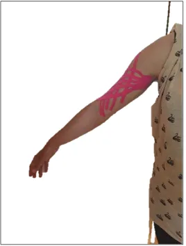 Figura 10. Técnica linfática a nivel del brazo. 