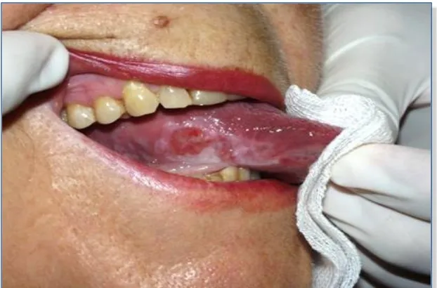 Figura 6: COCE con morfología endofítica localizado en borde lateral derecho de lengua