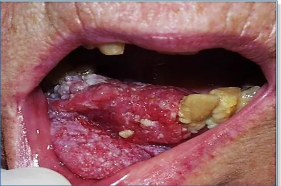 Figura 7: COCE con morfología exofítica localizado en suelo de boca. 
