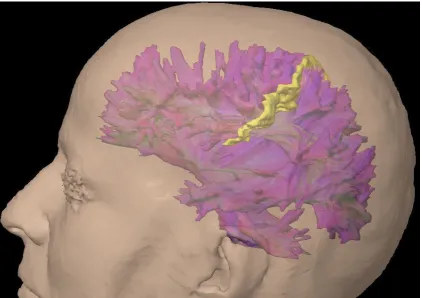 Figura 1. Reconstrucción de tractografía por tensor de difusión o DTI (Diffusion Tensor Imaging) de las 