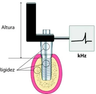 Fig. 1.2. Esquema de la técnica AFR (Sennerby y Meredith 1998). En negro, el transductor atornillado al implante