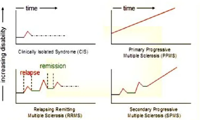 Figura 1. Cursos clínicos de EM. Los pacientes con EM pueden presentar 3 formas de https://sbvimprover.comFuente: primariamente progresiva (SP)