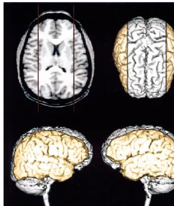FIG. 1.The lateral-perisylvian region considered in this study (colored tissue). The sagittal plane separating the frontoparietaloperculum and the insula was used to medially limit this region (top left).