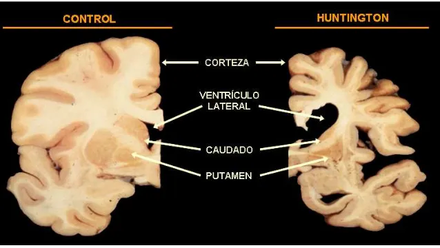 Figura 1. Patología de la enfermedad de Huntington. Secciones coronales en las que se aprecia atrofia de la página volumen del ventrículo lateral, en el cerebro afectado por la enfermedad de Huntington