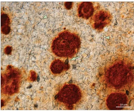 Figura 2. Neuropatología de la EA en el cerebro de un individuo con SD. Inmunohistoquímica del córtex frontal de una persona de 46 años con SD