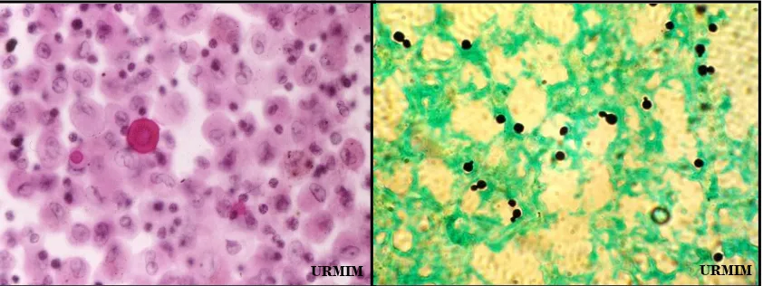 Figura 5: Levaduras capsuladas de  Cryptococcus gattii, tinción de tinta china 
