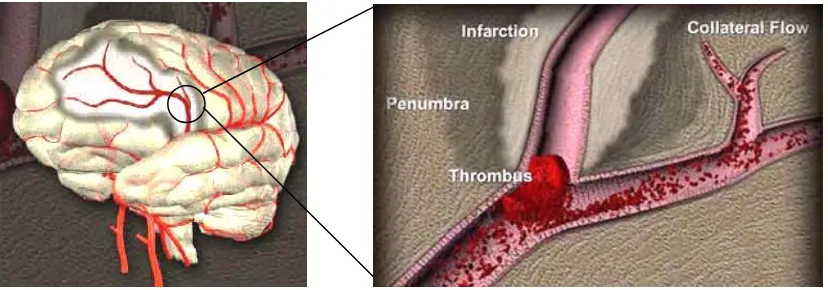 Figura 1. Núcleo y penumbra en una isquemia cerebral. Tras la interrupción del flujo sanguíneo provocado por un trombo se pueden diferenciar dos áreas: el core o núcleo de la lesión (más claro), y la penumbra o región periférica (más oscuro) donde puede ll