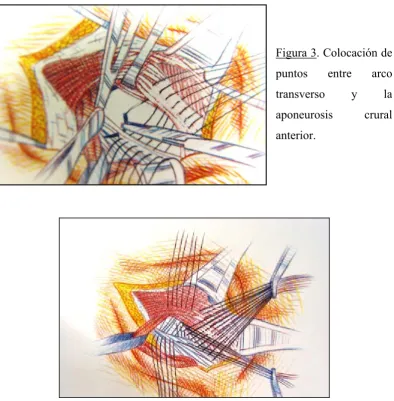 Figura 3. Colocación de 