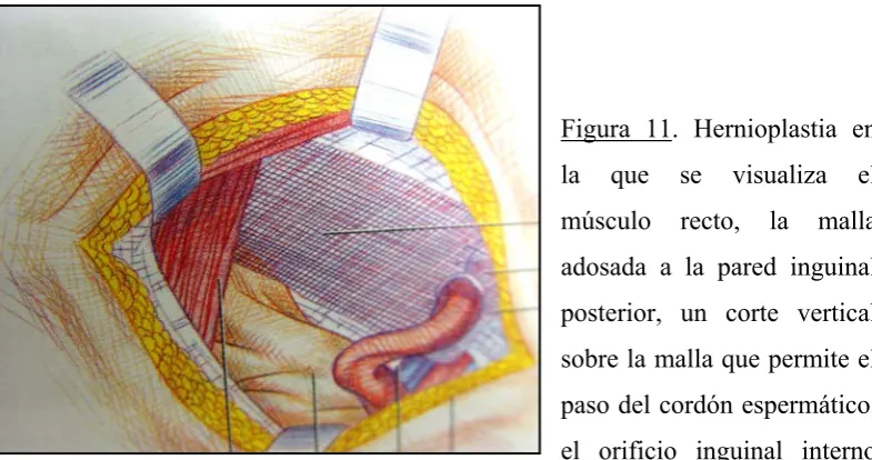 Figura 11. Hernioplastia en 