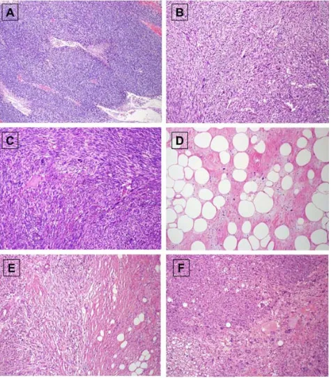 Figura 3. Tinciones representativas de los sarcomas objeto de estudio. A) TMVNP; B) Leiomiosarcoma 