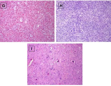 Figura 3 (continuación). Tinciones representativas de los sarcomas objeto de estudio. A) TMVNP; B) Leiomiosarcoma no uterino; C) Leiomiosarcoma uterino; D) Liposarcoma bien diferenciado; E) sinovial; I) Sarcoma pleomórfico indiferenciado