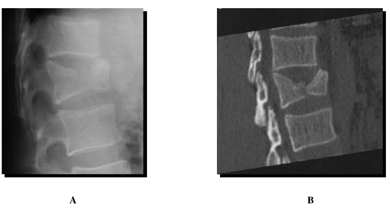 Figura 1.8. Fractura estallido tipo A3.3.1. A: radiografía lateral. B: reconstrucción de TAC donde se objetiva 