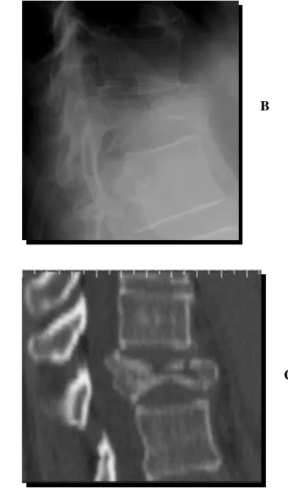 Figura 1.10. Fractura estallido tipo A3.3.3. A: radiografía antero-posterior donde se objetiva la disminución 