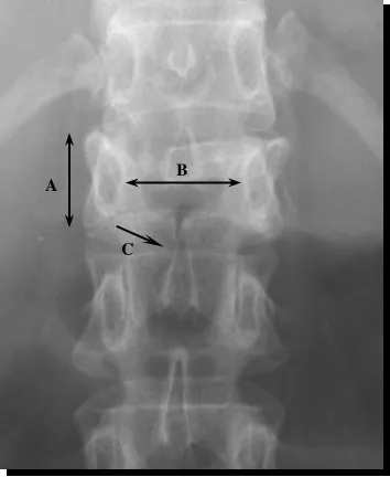 Figura 1.12. Radiografía lateral. A: disminución de 