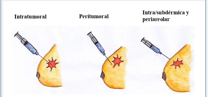 Fig. 1.4: Representación gráfica de los diversos tipos de inyección del radiofármaco en la técnica del Ganglio Centinela en el cáncer de mama.