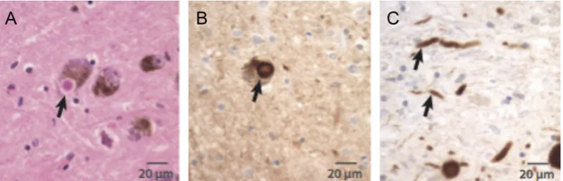 Figure 3. Pathophysiological model of the basal ganglia in (A) Normal state. Corticostriatal activity excites neurons within the striatum activating the “direct” striato-globus pallidus pars interna pathway and the indirect striatal-globus pallidus pars ex