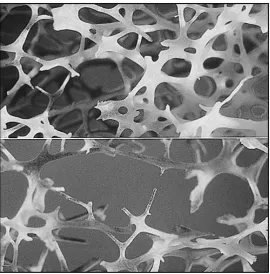 Figure 1. Microarchitecture of the bone. A normal bone appears in  the upper part, while an osteoporotic bone with low BMD and damaged microarchitecture appears in the lower part (Extracted from http://www.noslynn.org.uk/img/bone-large-1.jpg)