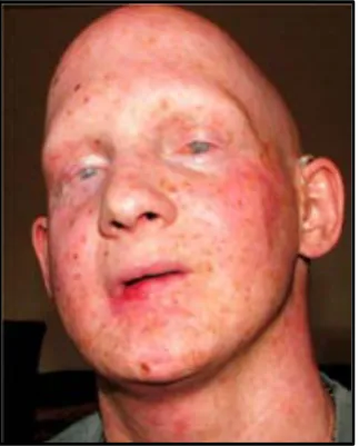 Figura 18. Características de progeria segmental en un paciente AF. Se trata de un 