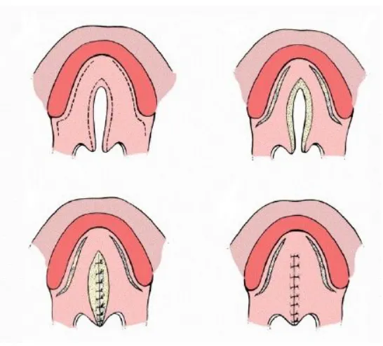 Figura 4. Palatoplastia según Von Langenbeck. 