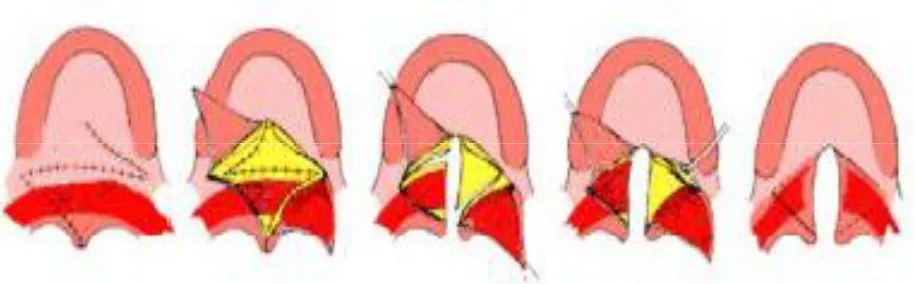 Figura 5. Palatoplastia según Furlow. 