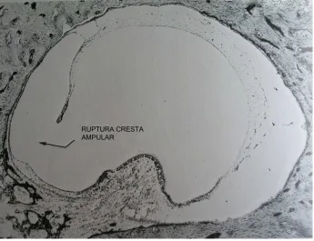 Figura 6.- Ruptura de la cresta ampular. Modificada de Schuknecht. (58)