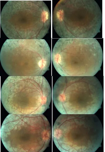 Figure 1.-  Fundus photographs of patient #1 (propositus) (a,b) and affected siblings 
