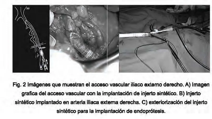 Fig. 2 Imágenes que muestran el accesc, vascular iliaco externo derecho. A) Imagen 