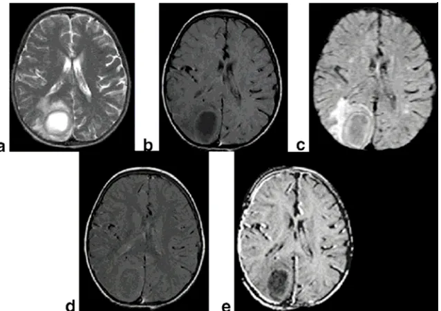 Figura. Muestra una imagen ponderada en T2, que evidencia una lesión quística bien redondeada hiperintensa con edema perilesional en la región occipital derecha b