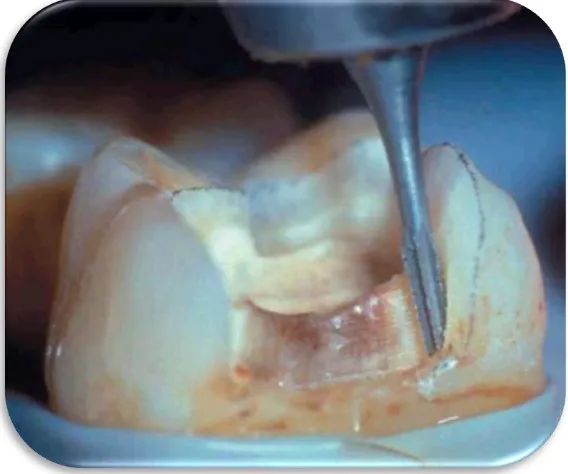 Fig. 20 Eliminación de esmalte sin soporte dentinario.14 