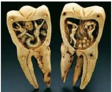 Fig.2 Gusano de la caries dental (Fuente: 