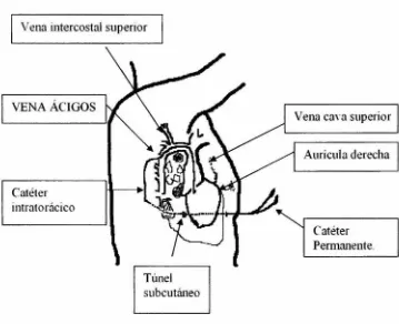 Fig. l. Relaciones anatómicas para colocación de catéter Permanente. 20 