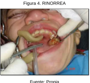 Figura 4. RINORREA 