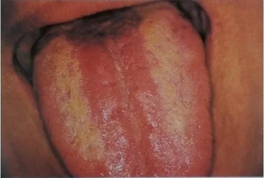 Figura 5. Candidiasis eritematosa.  32