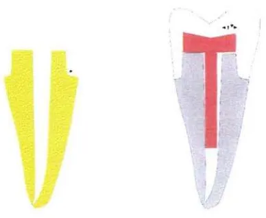 fig. 4 Tamallo de la restauración colada y estructura dentaria 