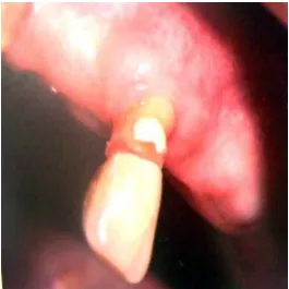 Fig. 6 Selección inicial del diente (6)                                   Fig. 7 Reducción coronal (6) 