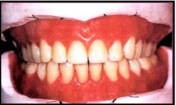 Fig. 1  Sobredentadura (3) 