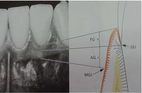 Fig.1 Divisiones de encía. Glickman 