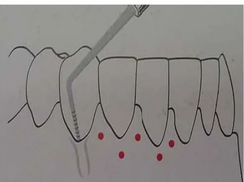 Fig. 14. Incisión festoneada. Glickman 