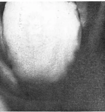 Fig.  4:  Ulceración  por  decúbito  a  nivel  lingual.  Tras  la  pal­